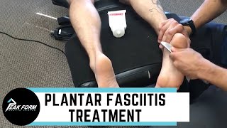 Plantar Fasciitis Treatment San Diego Graston Chiropractic [upl. by Hutson242]