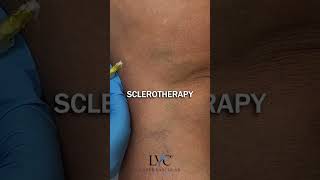 Sclerotherapy surgerysuccess medicaltiktok [upl. by Pelagi639]