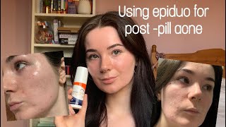 Starting Epiduo for acne 4 week update  tips 💖 [upl. by Burrow]