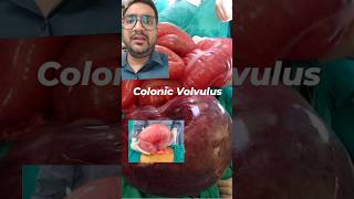 Colonic Volvulus I Sigmoid Volvulus treatment in Delhi Noida [upl. by Lamont]