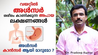 വയറിലെ അൾസർ കാൻസർ ആയി മാറുമോ  ഈ അപായ ലക്ഷണങ്ങൾ സൂക്ഷിക്കുക  Ulcer Malayalam [upl. by Rhyne662]