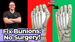 TOP 13 Ways to Shrink Bunions Naturally 1 HUGE SECRET [upl. by Weisburgh]