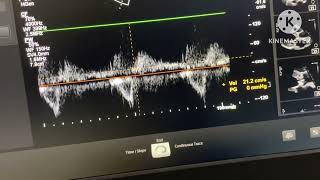 Severe Aortic regurgitation with Chronic Infective Endocarditis [upl. by Eanaj]