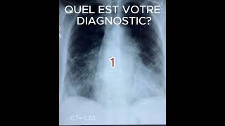 DYSPNEE DE REPOSradiologystudent femmemedecine [upl. by Ytrebil]