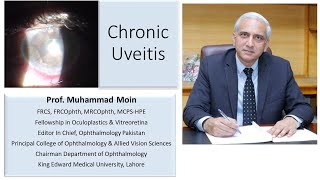 Chronic Uveitis with Secluso Pupillae [upl. by Rodina]