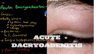 Acute dacryoadenitis  lacrimal system [upl. by Madelaine]