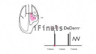 Mitral stenosis murmur [upl. by Kashden]