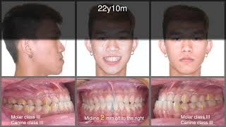 Treatment of CIII Malocclusion with Insignia｜【Chris Chang Ortho】CC642 [upl. by Whatley]