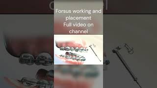 Forsus fixed functional appliance orthodontics braces dentist [upl. by Sabino]