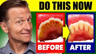 Natural Solution for Plaque Cavities and Gingivitis [upl. by Sims]