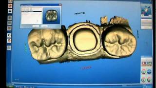 Cerec 3D Crown Master Mode stepbystep [upl. by Cochard364]