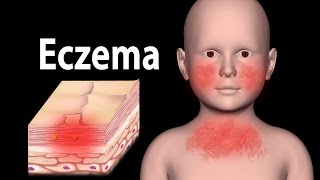 Eczema Animation [upl. by Ennayllek]