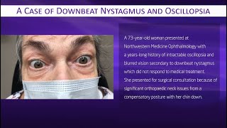 A Case of Downbeat Nystagmus and Oscillopsia [upl. by Iglesias181]