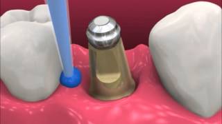 Smyl Manatee  Dental Implant Procedure [upl. by Enoek]