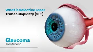 What is Selective Laser Trabeculoplasty SLT  Glaucoma Treatment 3D [upl. by Kirstin445]