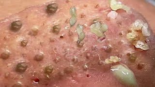 Loan Nguyen Acne Treatment 1772h [upl. by Ileek]