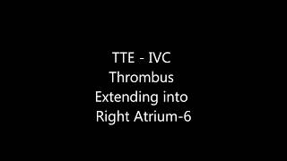 IVC Thrombus Extending into Right Atrium  Transthoracic Echocardiogram TTE [upl. by Analak]