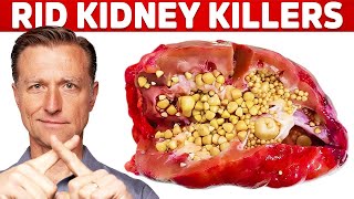 Clean Your Kidneys of Uric Acid and Oxalates [upl. by Enomal]