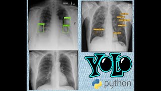 YOLO11 for Lung Cancer Detection  Early Lung Cancer Detection [upl. by Oniram]