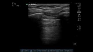 Lung ultrasound demonstrating the ABSENCE of lung sliding [upl. by Nalced]