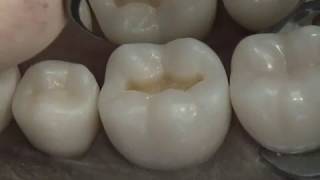 Class I Composite Preparation amp Restoration  Operative Dentistry [upl. by Nadeau194]