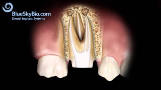 Patient Treatment Videos Root Canal Retreatment [upl. by Aindrea512]