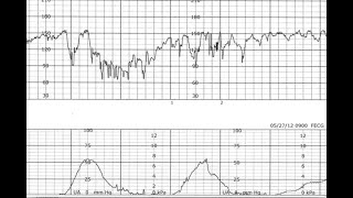 Fetal Monitoring Segment 4 Fetal Heart Decelerations [upl. by Lehsar]