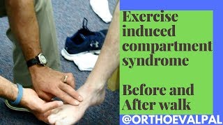 Exercise Induced Compartment Syndrome Signs and Symptoms [upl. by Naira]