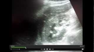 EMPHYSEMATOUS PYELONEPHRITIS [upl. by Helen]