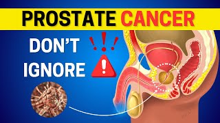 10 early signs of Prostate Cancer  symptoms and treatment [upl. by Fidellia]