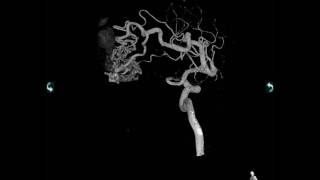 ArterioVenous Malformation AVM [upl. by Ittap]