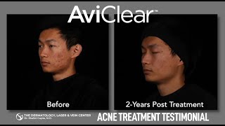 AviClear Acne Treatment Patient Testimonial [upl. by Rivi]