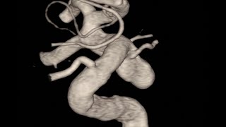 Posterior comunicating artery aneurysm Balloon assisted embolization [upl. by Notniuqal]