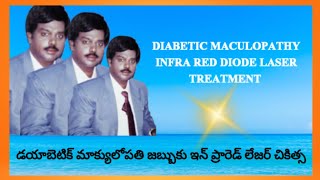 DIABETIC MACULOPATHY INFRA RED DIODE LASER TREATMENT  DrBSUBBARAO [upl. by Loredana]