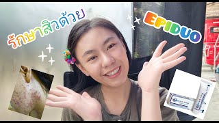 รีวิวการรักษาสิวด้วย Epiduo EPIDUOใช้เฉพาะกลางคืนนะคะ [upl. by Astrahan]