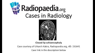 Closed lip schizencephaly Radiopaediaorg Cases in Radiology [upl. by Arodasi425]