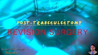 MIIQ 100 PostTrab Revision Surgery  Glaucoma Revision Surgery  DR MD IFTEKHER IQBAL RAJU [upl. by Margo]