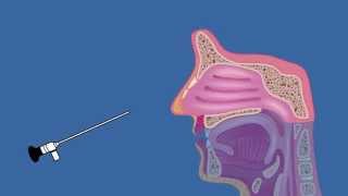 What is Nasal Endoscopy [upl. by Eugenie]