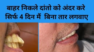 बाहर निकले दांतों का इलाज सिर्फ 4 दिन में बिना तार लगवाए Smile designSmile makeoverदाँतteeth [upl. by Eissirhc]