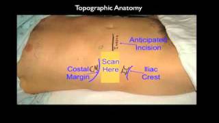 Ultrasound Guided Transversus Abdominis Plane Block [upl. by Ailerua]