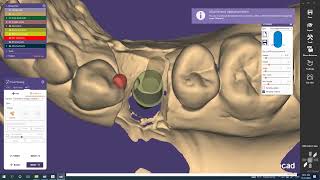 Custom Abutment Design with Exocad [upl. by Eimma]