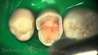 Dental Laser  Crown Prep Extracted [upl. by Eylrac]