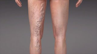 What are Varicose Veins [upl. by Oizirbaf]