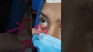 🔴Eye Ointment  How to Apply Eye Ointment Simple [upl. by Asaert]