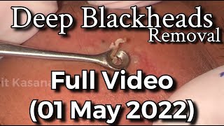 Deep Blackheads Removal with Cotton Bud amp Extractor Full Video By DrLalit Kasana [upl. by Tayib]