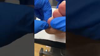 Australian Podiatrist Removes Pinch Callus with Docpods  Effective Callus Removal Techniques [upl. by Eagle]