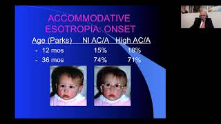 Accommodative Esotropia and its Complications [upl. by Gilda]