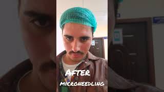 microneedling before after for your experience skin acne scar [upl. by Stoneman]