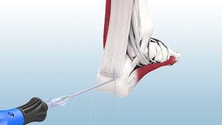 Haglunds Excision and Achilles Reconstruction Using the CuffLink™ System  CONMED Animation [upl. by Hairahcaz]