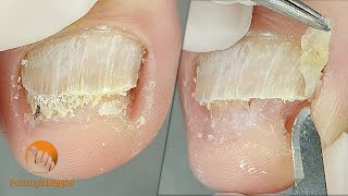 2 cases 1 video XI  1 Onychomycosis  2 Onychogryphosis Podological treatment [upl. by Auqenet101]